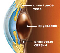катаракта мультифокальная линза