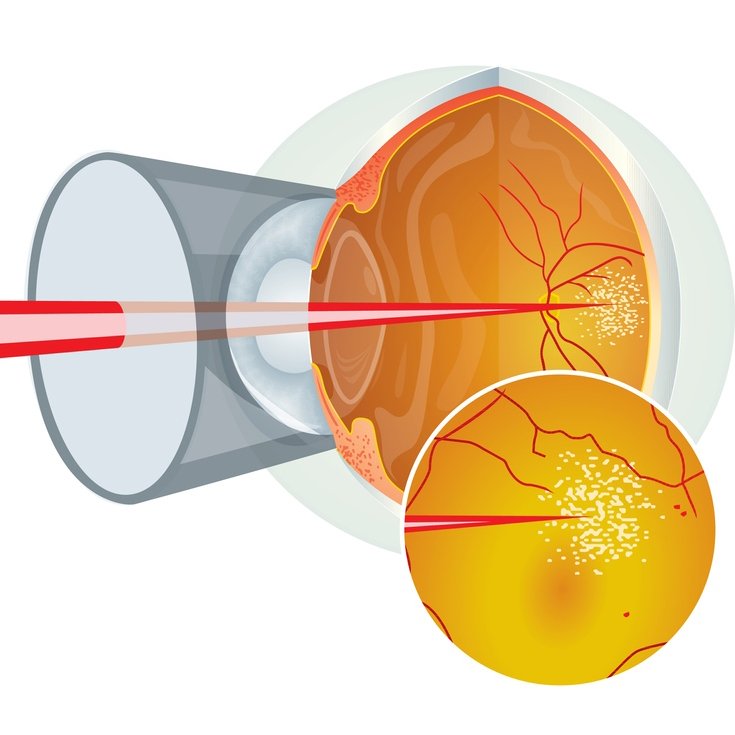 Отслоение сетчатки глаза - симптомы, причины, лечение с помощью операции и  профилактика
