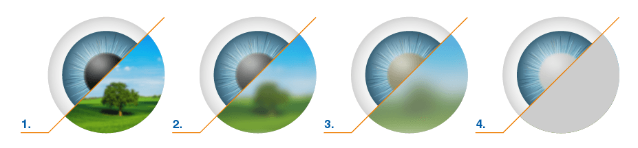 стадии развития катаракты
