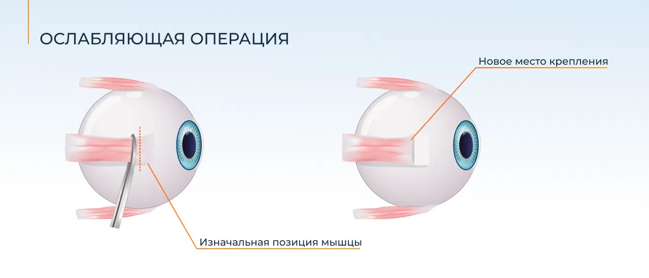 резекция косоглазия