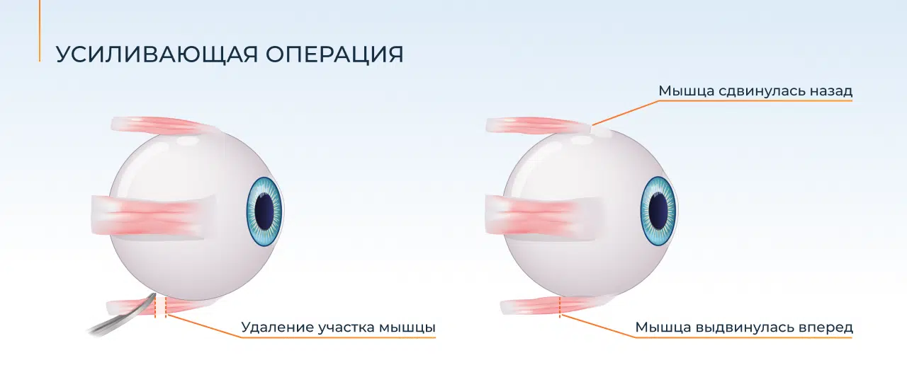 рецессия косоглазия