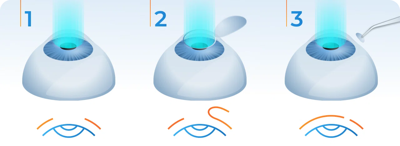 методы лазерной коррекции зрения