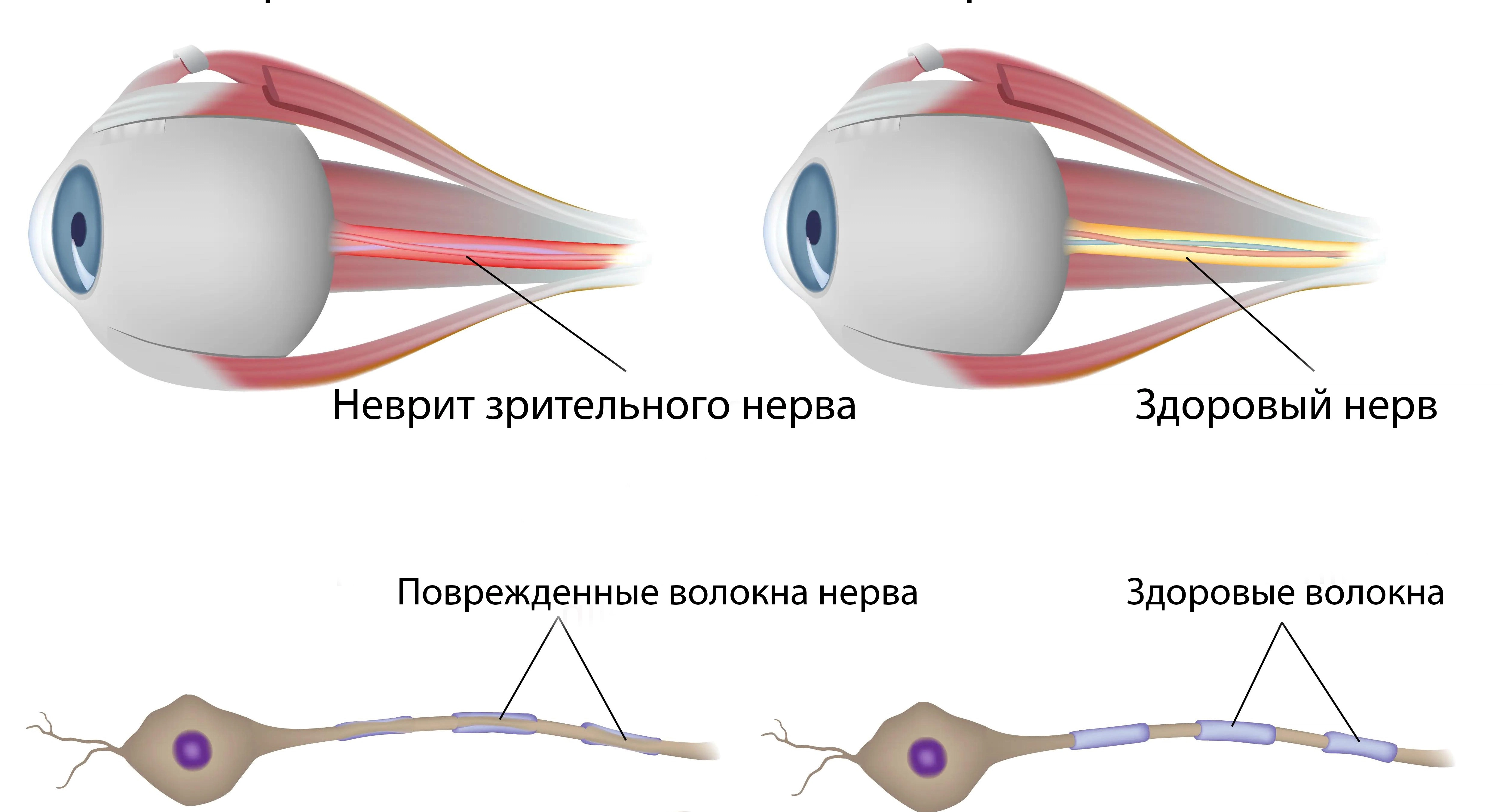 неврит зрительного нерва и здоровый глаз