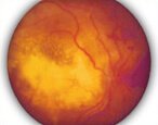Операция глаукомы катаракта при отслоении сетчатки thumbnail