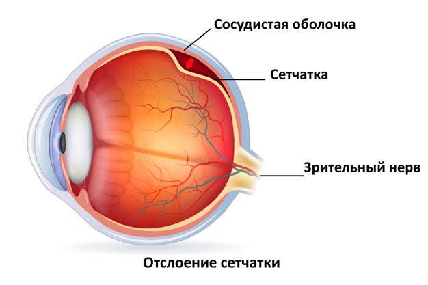 Лечение отслойки сетчатки глаз thumbnail