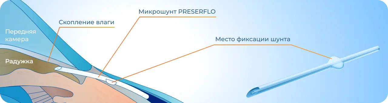 Имплантация микрошунта Preserflo при глаукоме