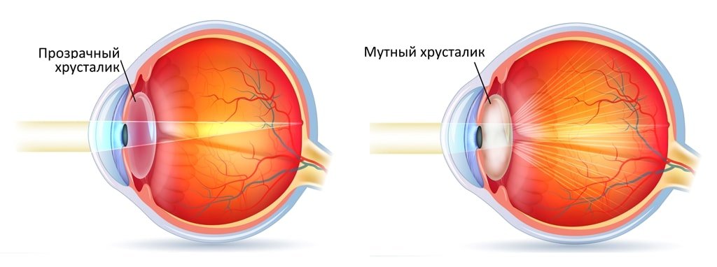 Что такое катаракта и как с ней бороться?