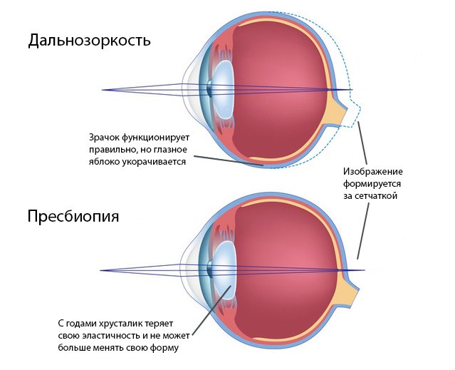 Что такое нечеткое зрение? Причины и способы лечения