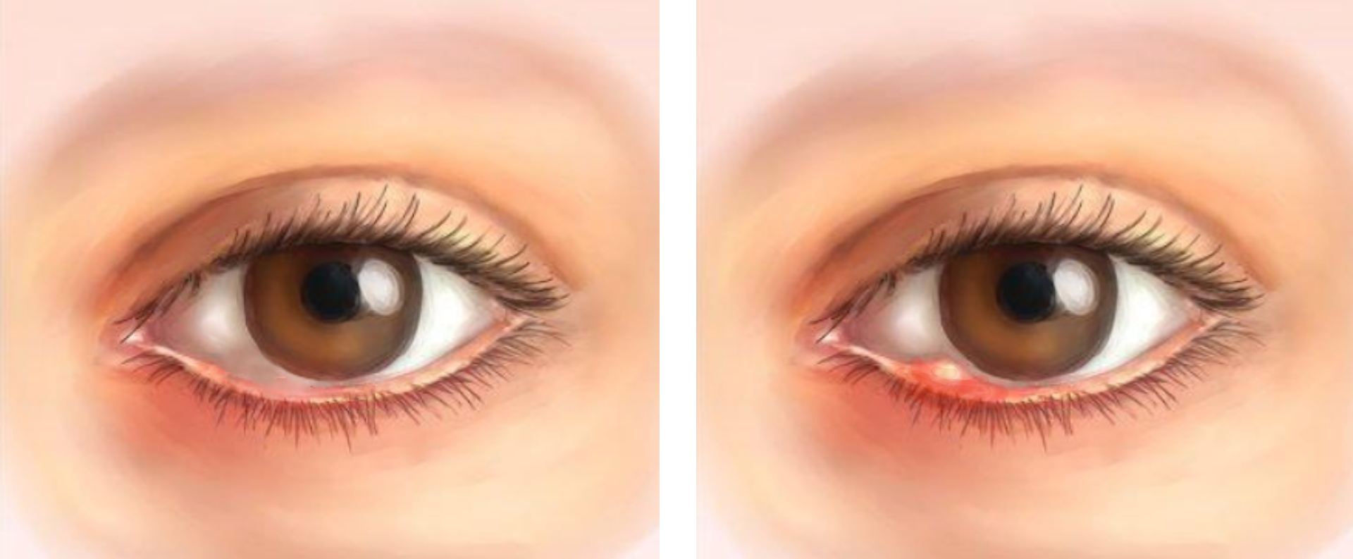 Лечение ячменя на глазу, причины возникновения ячменя, виды, стадии и симптомы - Здравица
