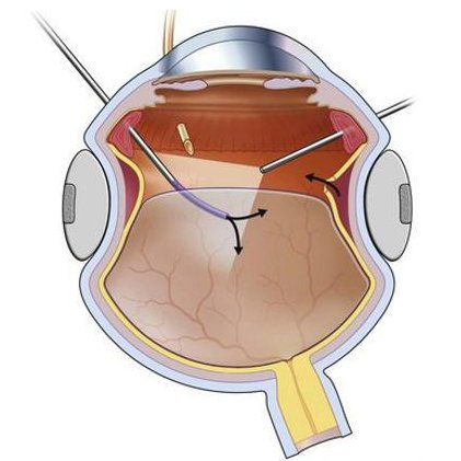 Отслойка сетчатки глаза катаракта лечение thumbnail