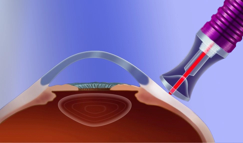 Транссклеральная микроимпульсная циклокоагуляция для лечения глаукомы в клинике Эксимер