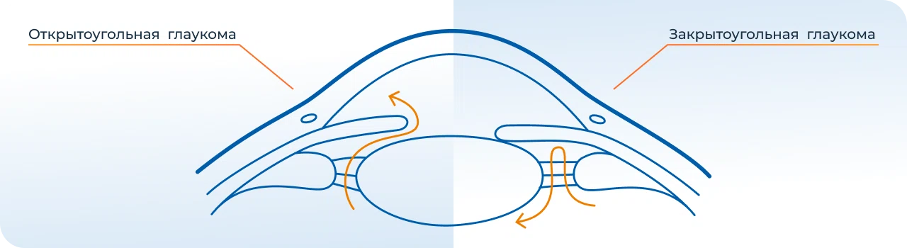виды глаукомы у пожилых людей