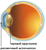 Коррекция астигматизма в хирургии катаракты thumbnail