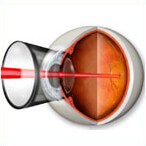 Дистрофия сетчатки глаза лечение лазером цена thumbnail
