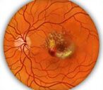 Медицина болезни сетчатки глаза thumbnail