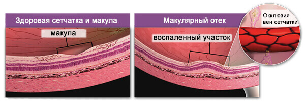Тромбоз глаза лечение введение капсулы в глаз озурдекс thumbnail