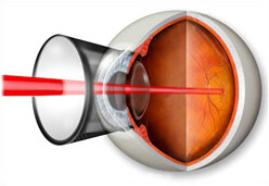 Укол в глаз расслоение сетчатки глаза лечение thumbnail