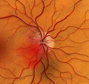 Отслоение сетчатки глаза при диабете thumbnail
