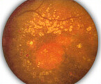 Сетчатка глаза болезни при сосудистых заболеваниях thumbnail