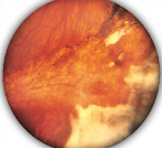 Заболевание сетчатки глаза симптомы лечение thumbnail