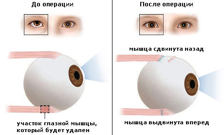 Послеоперационная повязка на глаз