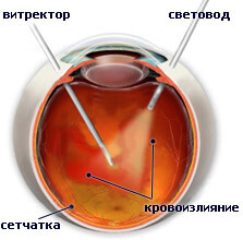 Лечение отслойки сетчатки глаза уколами thumbnail