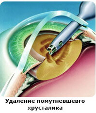 Операция глаукома катаракта замена хрусталика thumbnail