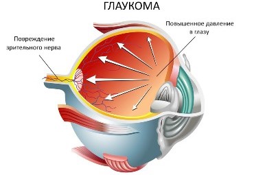 Что такое глаукома легких thumbnail