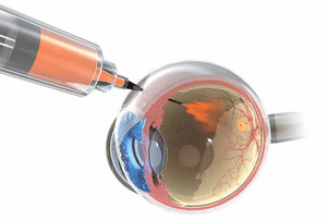 Лечение макулярной дегенерации сетчатки глаза thumbnail