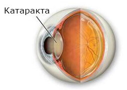 Катаракта глаза лечение операция стоимость thumbnail