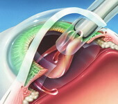 Стоимость хирургического лечения катаракты глаза thumbnail
